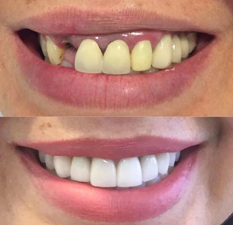 Implante antes e depois