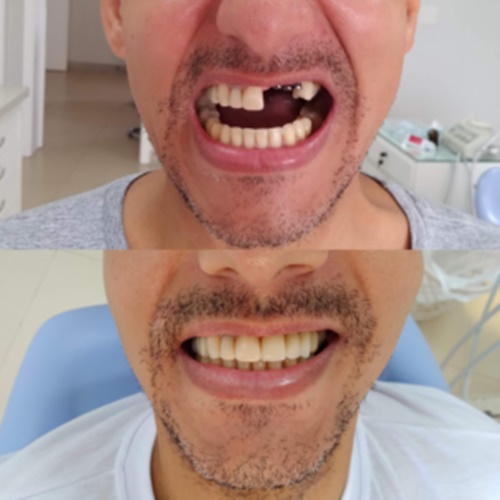 Implante antes e depois